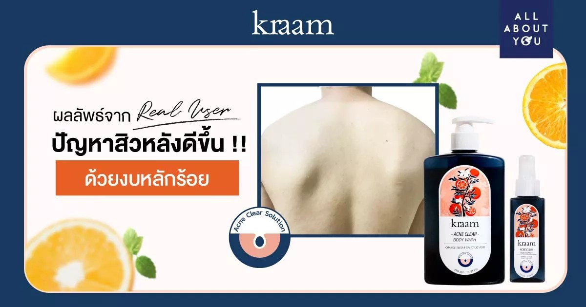 Kraam Acne Clear ผลลัพธ์จาก Real User ปัญหาสิวหลังดีขึ้นด้วยงบหลักร้อย